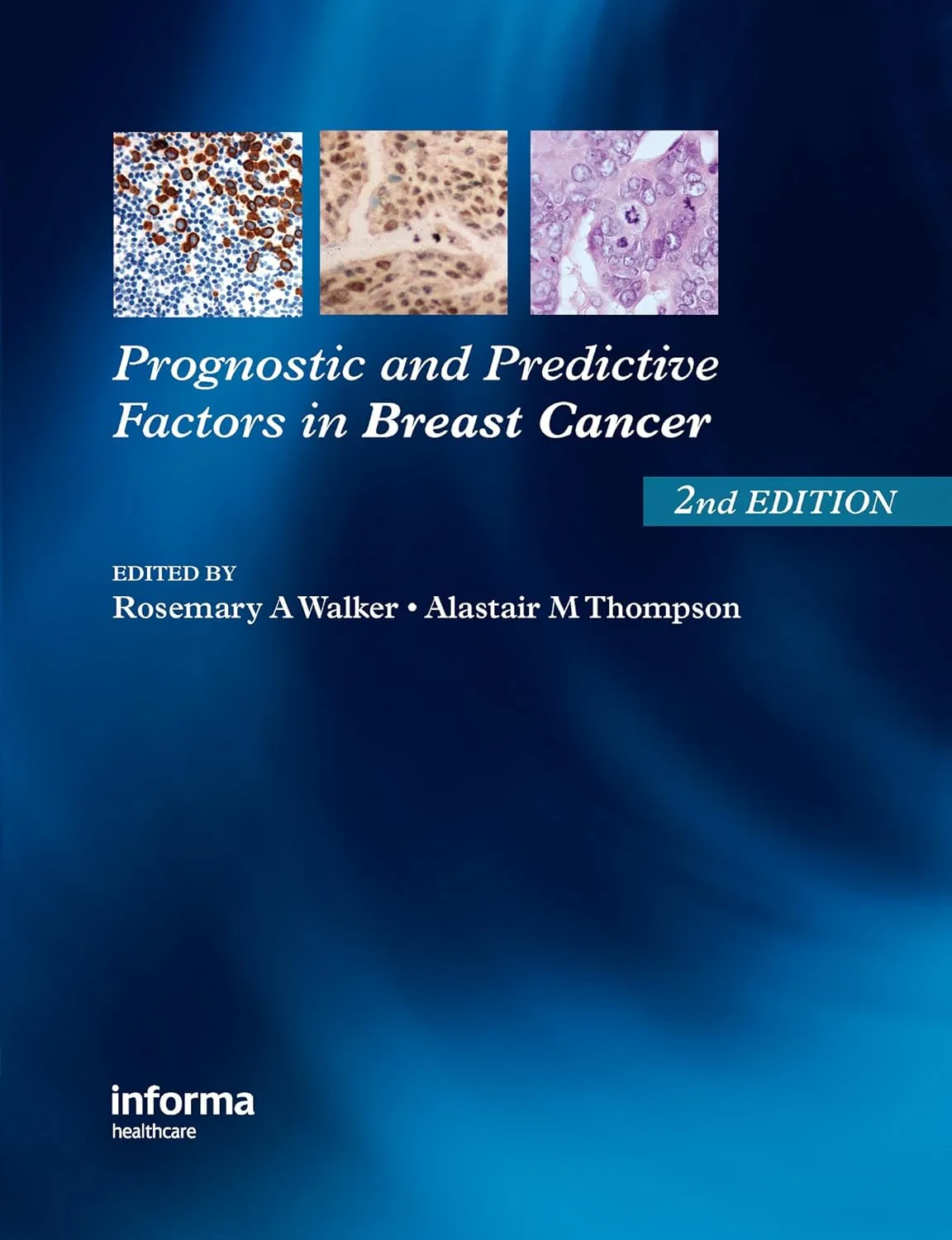 Coperta cărții "Prognostic and Predictive Factors in Breast Cancer" de Rosemary A. Walker, Alistair M. Thompson