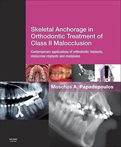 Coperta cărții "Skeletal Anchorage in Orthodontic Treatment of Class II Malocclusion" de Moschos A. Papadopoulos DDS Dr Med Dent