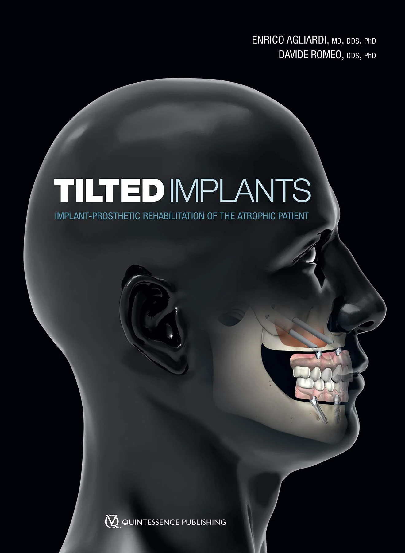 Tilted Implants: Implant-Prosthetic Rehabilitation...