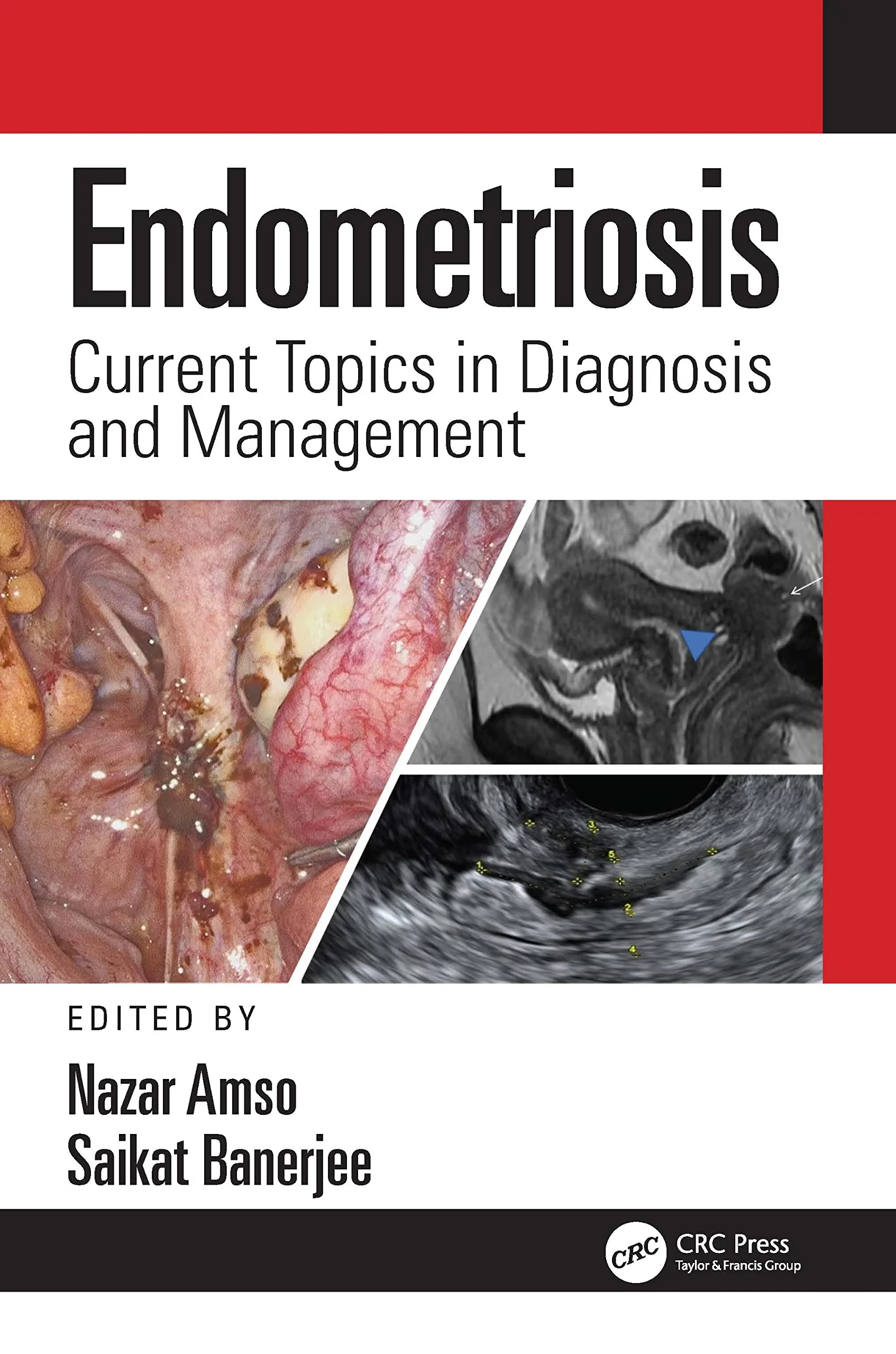 Endometriosis: Current Topics in Diagnosis and Man...