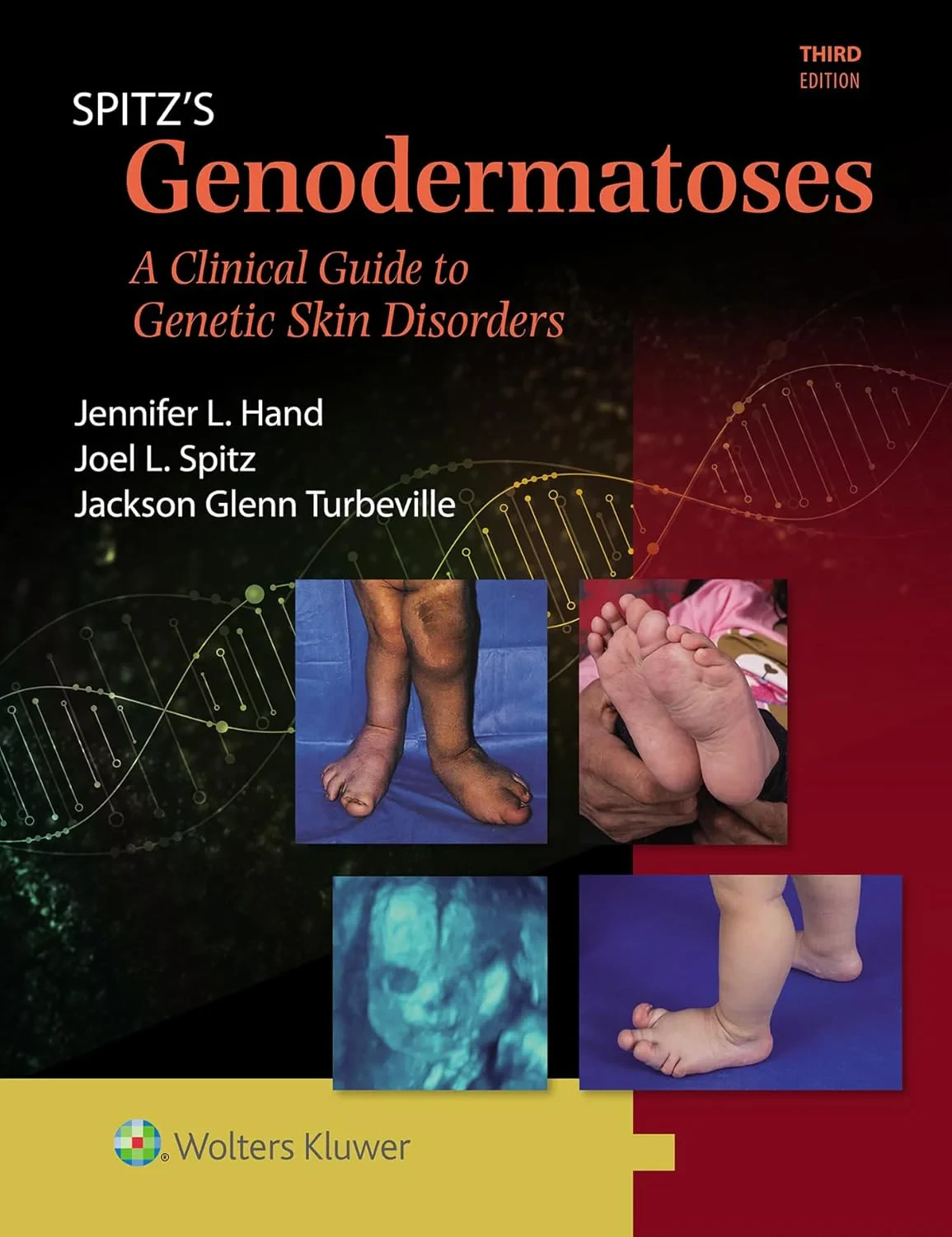 Spitz’s Genodermatoses A Full Color Clinical Guide...