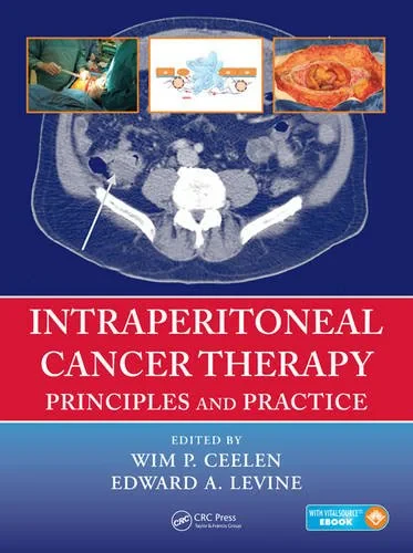 Intraperitoneal Cancer Therapy: Principles and Pra...