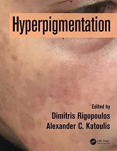 Hyperpigmentation