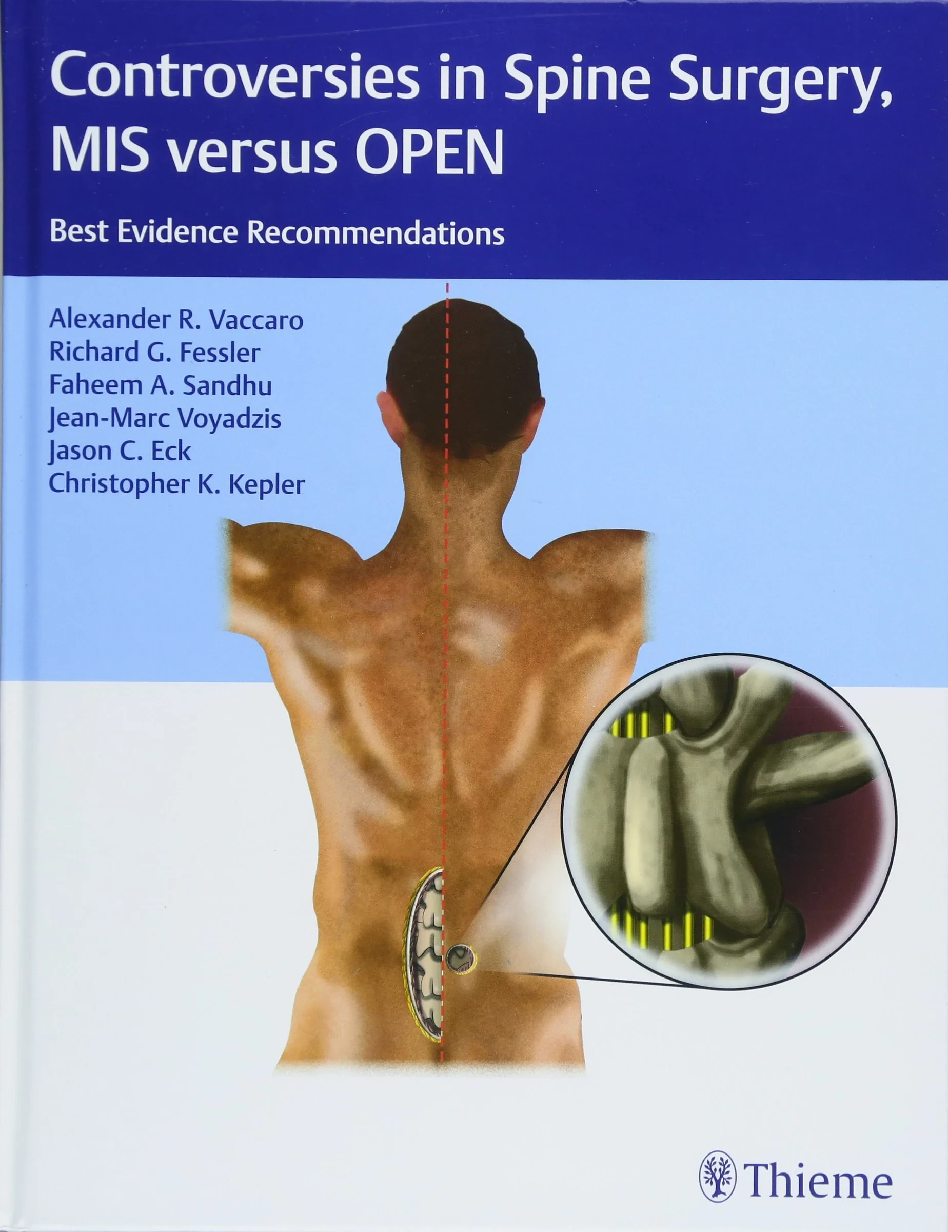 Coperta cărții "Controversies in Spine Surgery, MIS versus OPEN: Best Evidence Recommendations" de Richard Glenn Fessler, Alexander R. Vaccaro, Jason C. Eck, Faheem A. Sandhu, Jean-Marc Voyadzis, Christopher K. Kepler