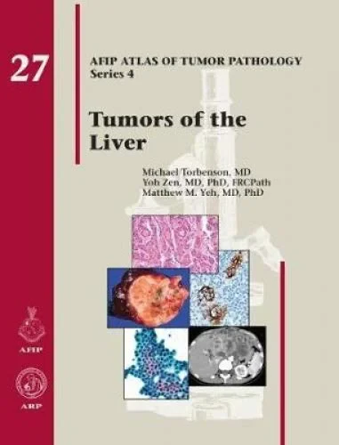 Tumors of the Liver 