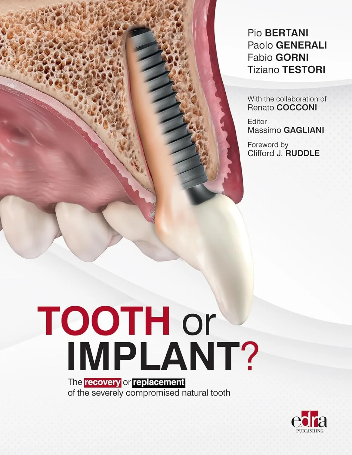 Coperta cărții "Tooth or Implant?: The recovery or replacement of the severely compromised natural tooth " de Fabio Gorni, Paolo Generali, Tiziano Testori