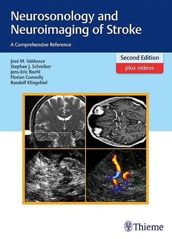 Neurosonology and Neuroimaging of Stroke: A Compre...