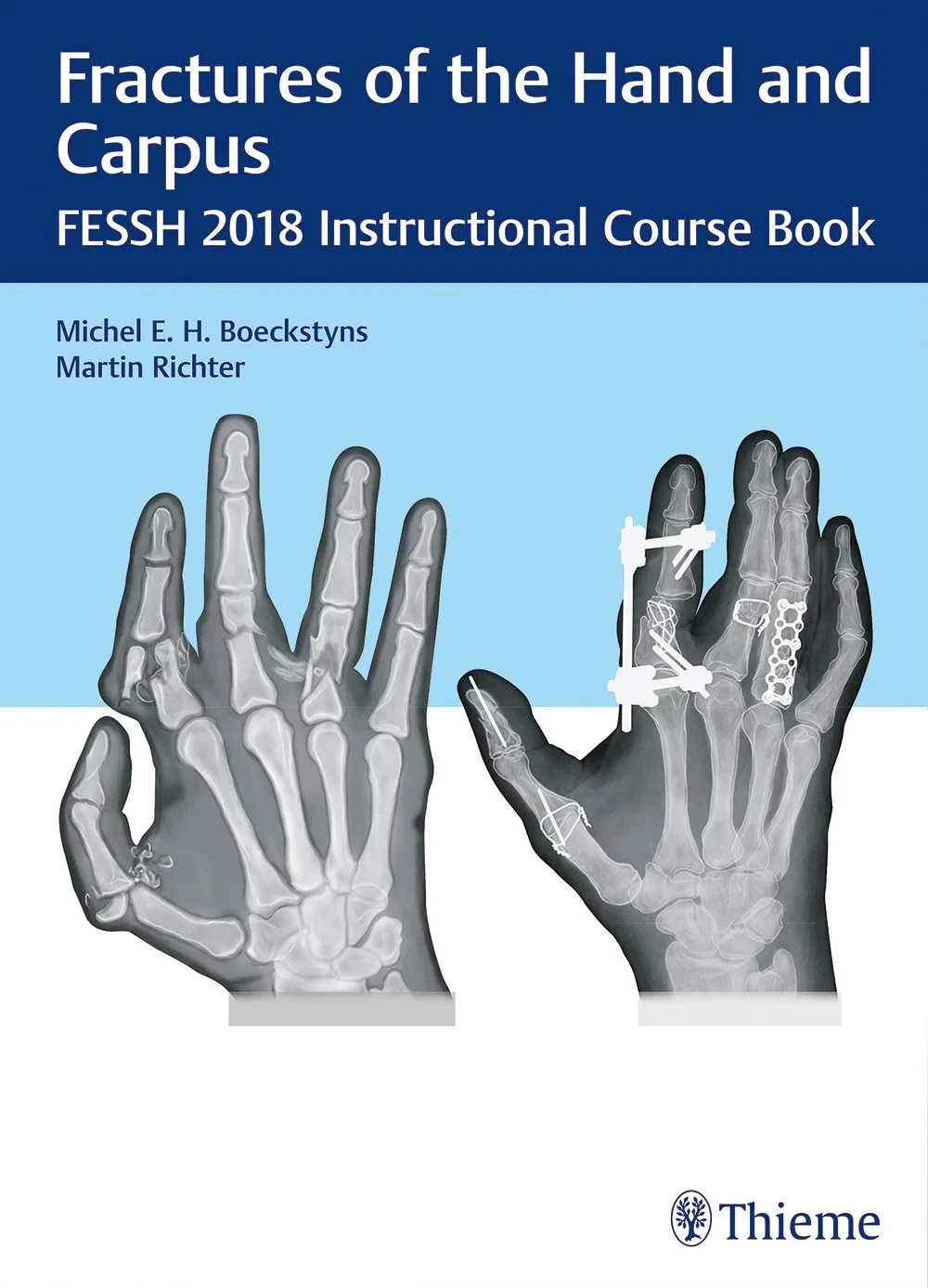 Coperta cărții "Fractures of the Hand and Carpus" de Michel E.H. Boeckstyns, Martin Richter