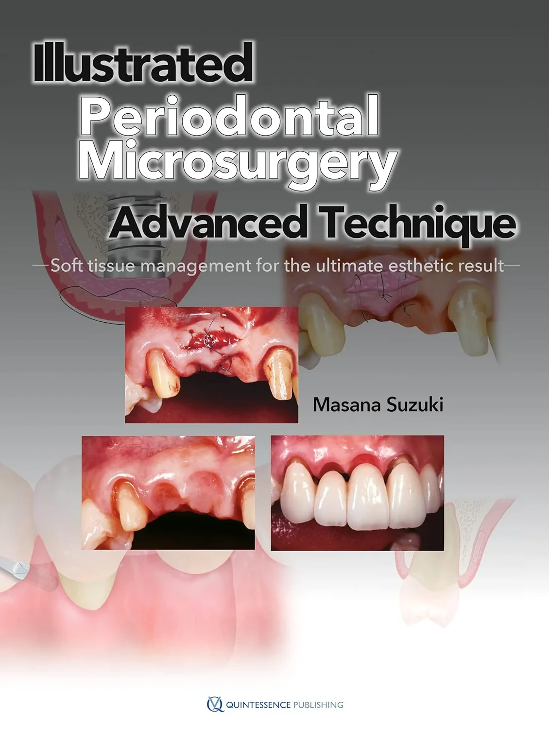 Coperta cărții "Illustrated Advanced Technique of Periodontal Microsurgery" de Masana Suzuki