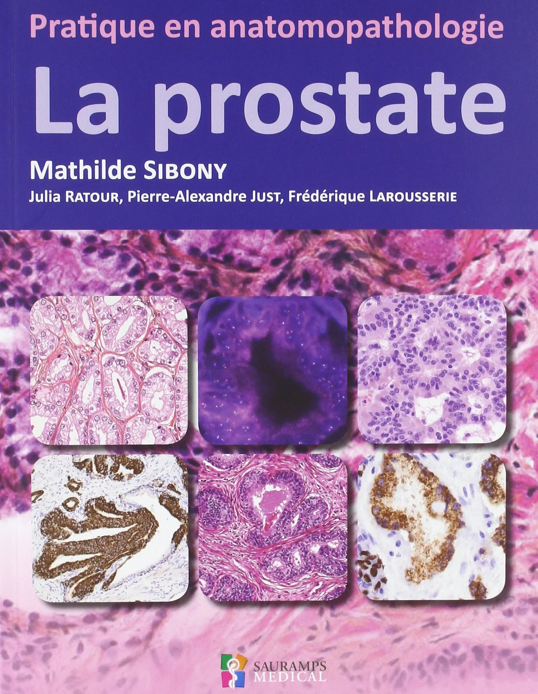 Coperta cărții "LA PROSTATE PRATIQUE EN ANATOMOPATHOLOGIE" de SIBONY MATHILDE