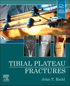 Tibial Plateau Fractures 