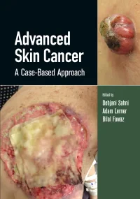 Advanced Skin Cancer: A Case-Based Approach