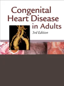 Congenital Heart Disease in Adults