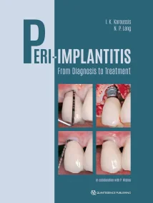 Peri-Implantitis: From Diagnosis to Treatment 