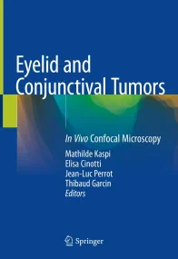 Eyelid and Conjunctival Tumors: In Vivo Confocal M...