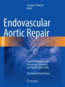 Endovascular Aortic Repair: Current Techniques wit...