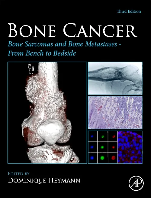 Coperta cărții "Bone Cancer" de autor necunoscut