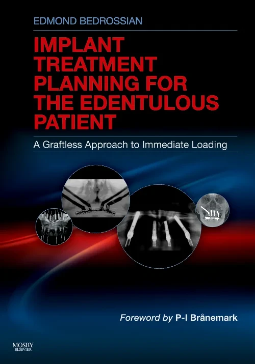 Implant Treatment Planning for the Edentulous Pati...