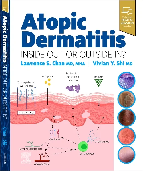 Atopic Dermatitis: Inside Out or Outside In