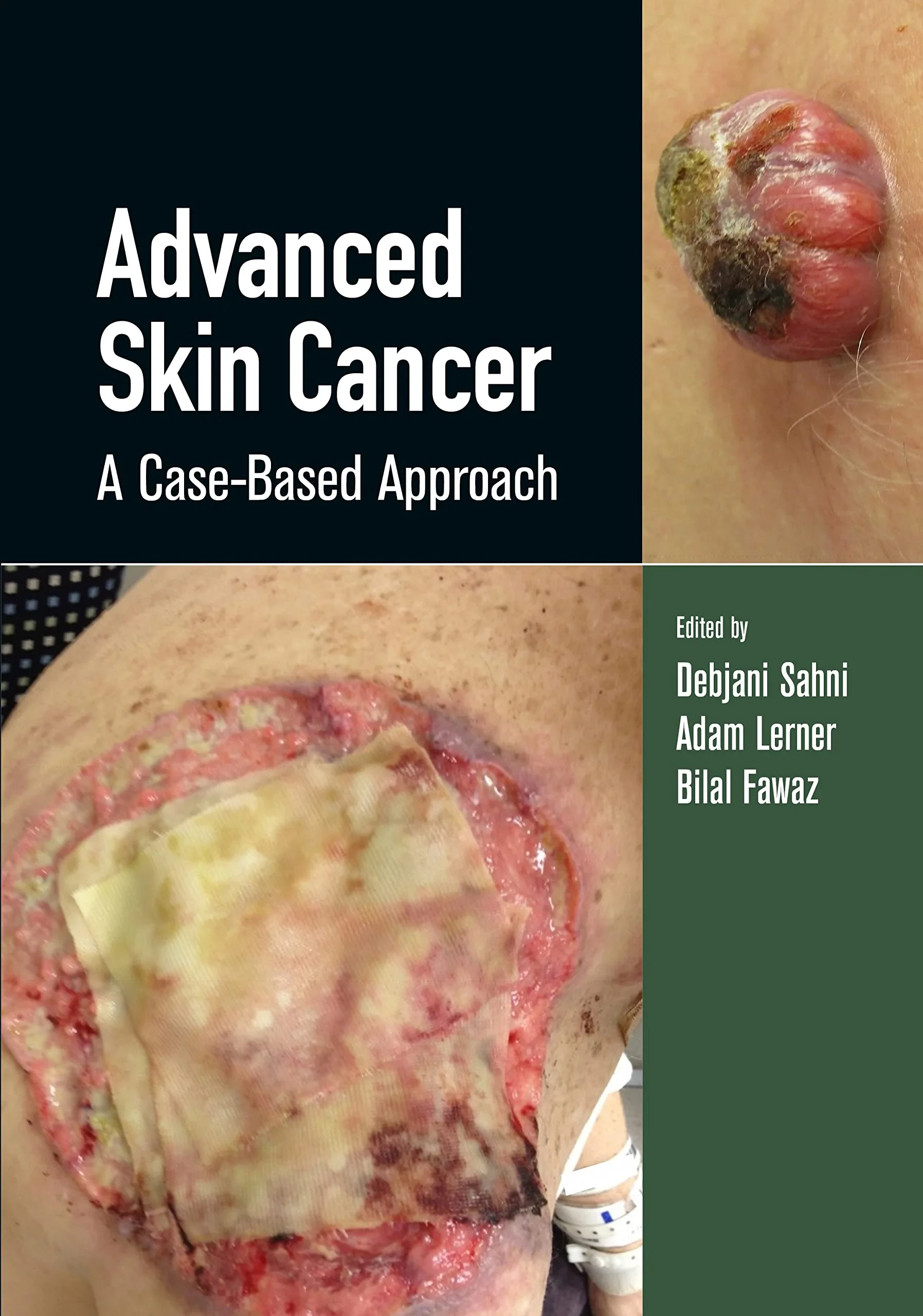 Coperta cărții "Advanced Skin Cancer: A Case-Based Approach" de autor necunoscut