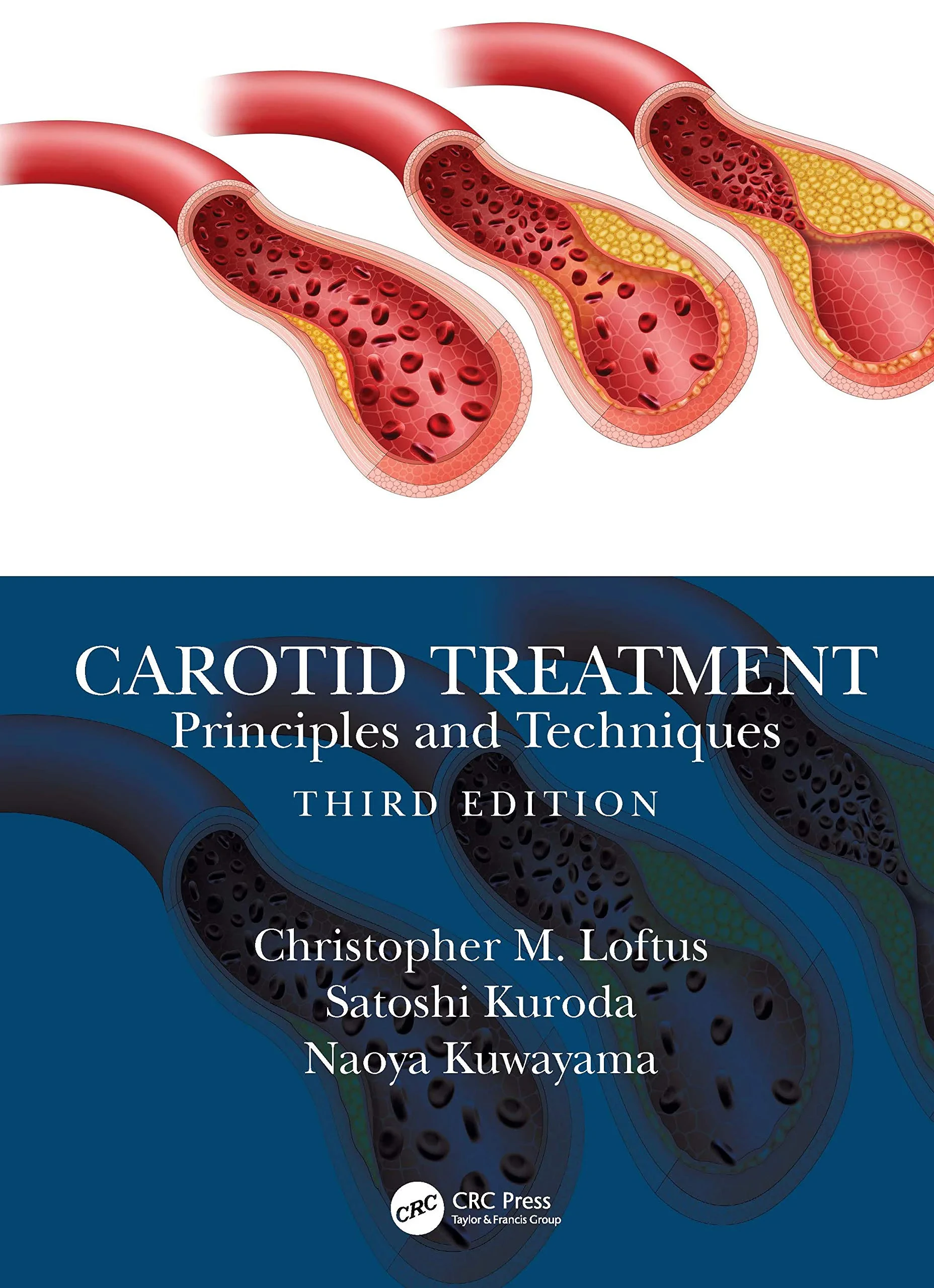 Coperta cărții "Carotid Treatment: Principles and Techniques" de autor necunoscut