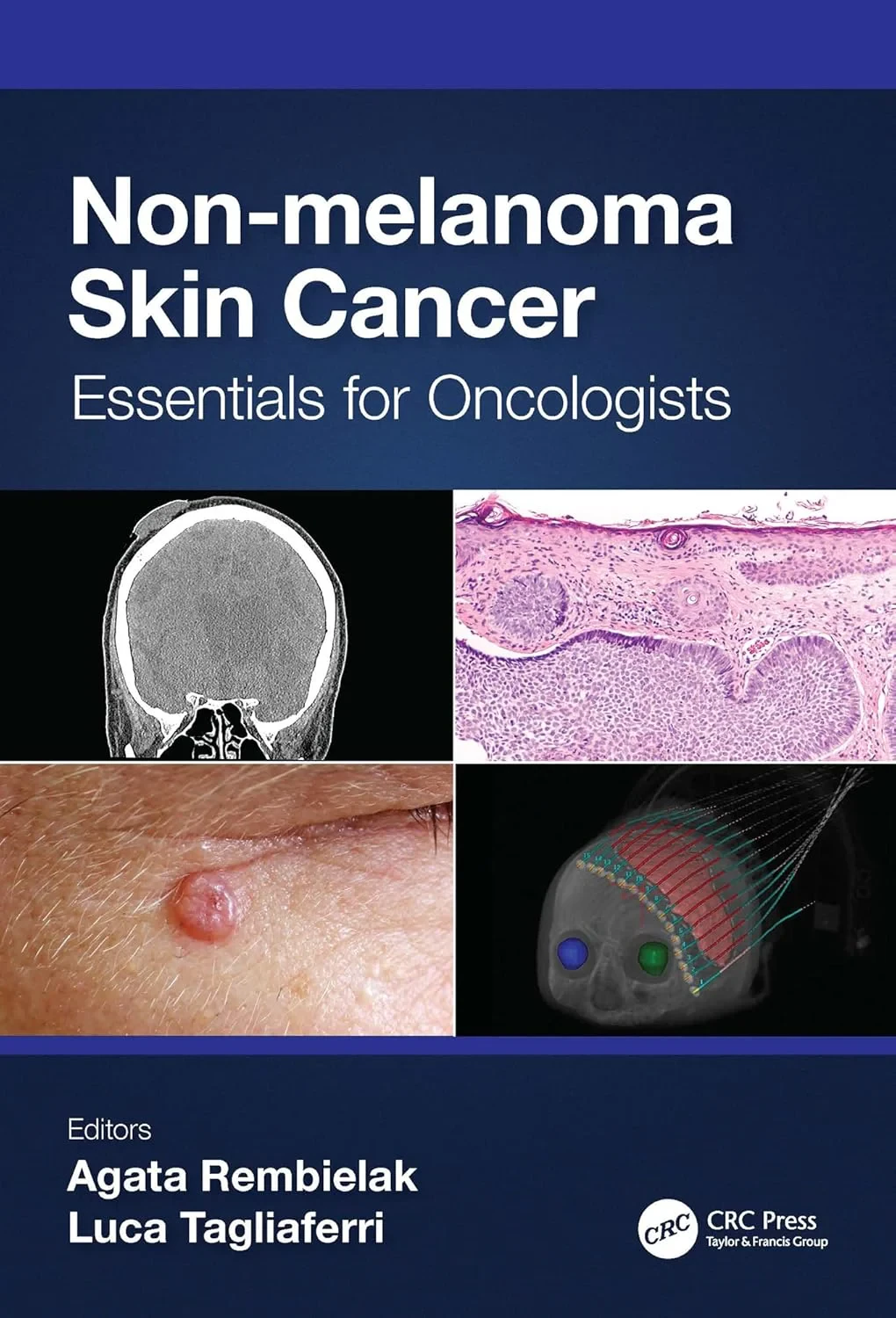 Coperta cărții "Non-melanoma Skin Cancer. Essentials for Oncologists" de autor necunoscut
