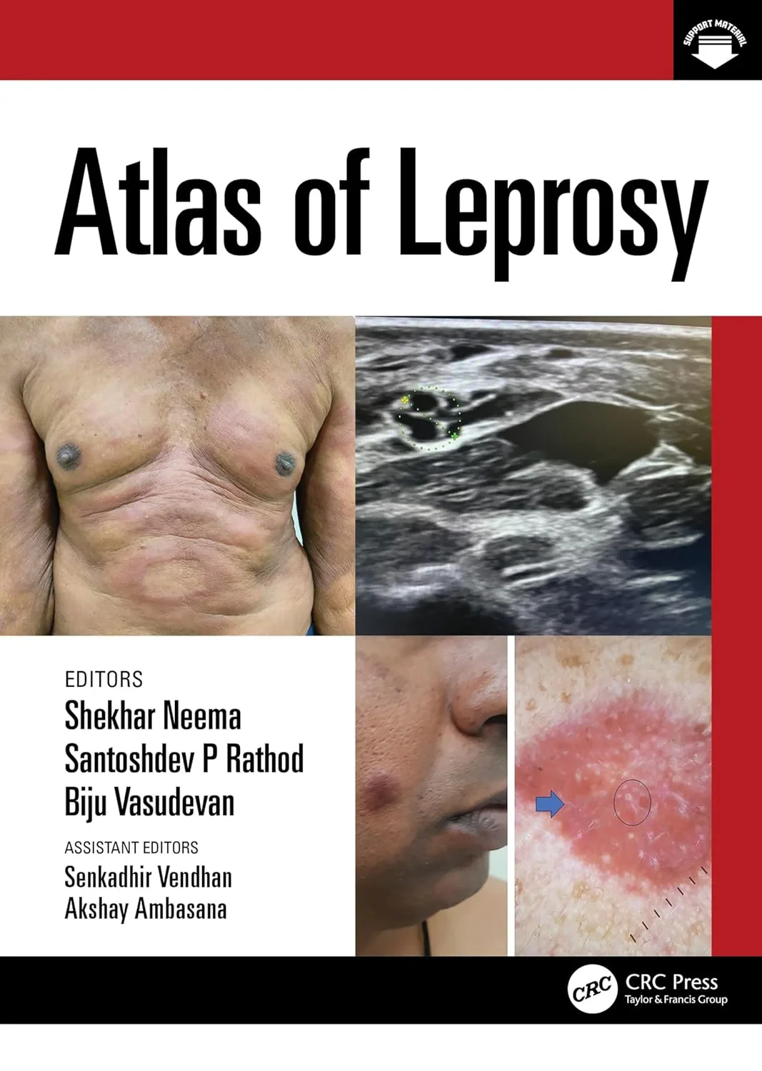 Coperta cărții "Atlas of Leprosy" de autor necunoscut