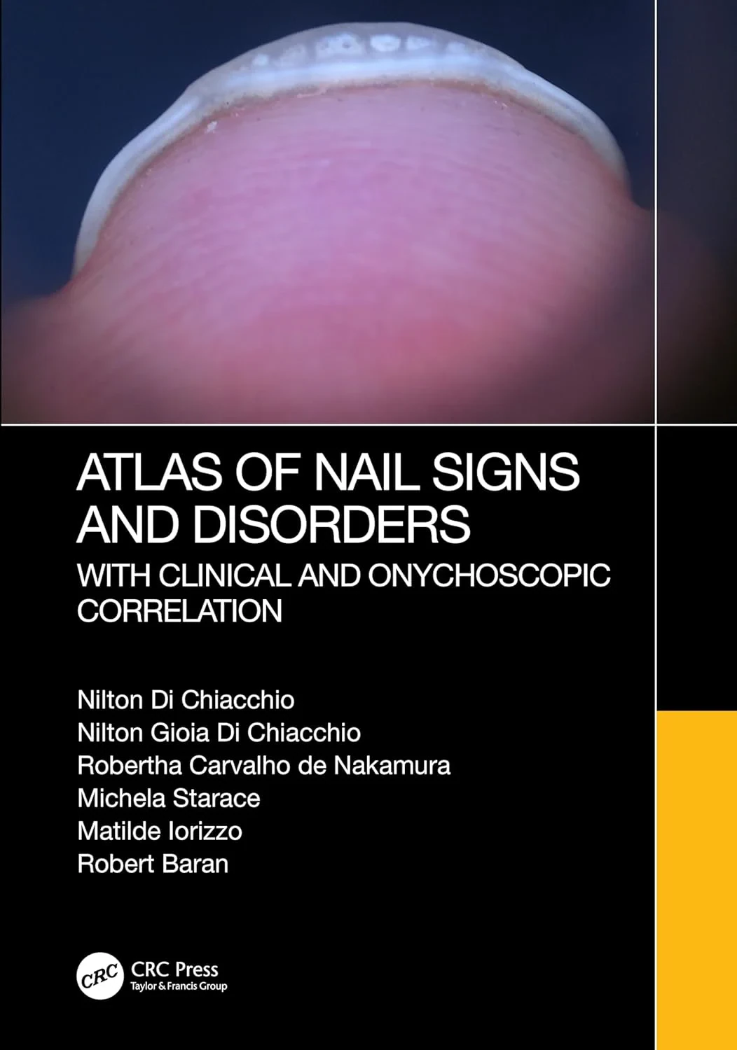 Coperta cărții "Atlas of Nail Signs and Disorders with Clinical and Onychoscopic Correlation" de autor necunoscut