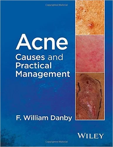 Coperta cărții "Acne: Causes and Practical Management 1st Edition" de autor necunoscut