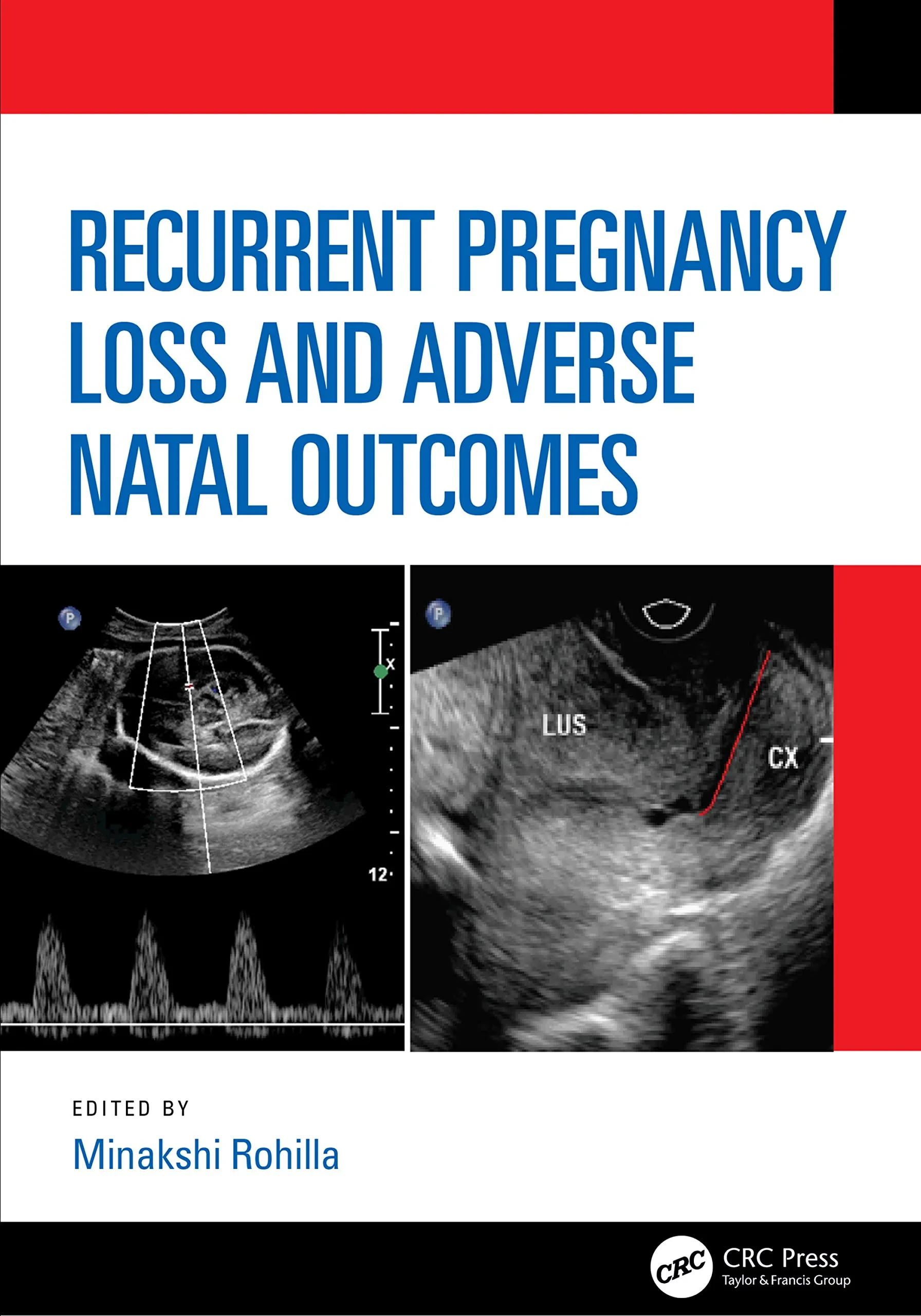 Coperta cărții "Recurrent Pregnancy Loss and Adverse Natal Outcomes" de autor necunoscut