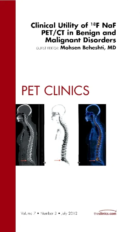 Clinical Utility of 18NaF PET/CT in Benign and Mal...