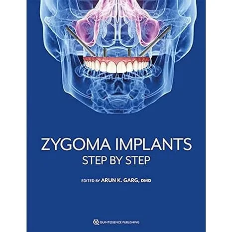 Coperta cărții "Zygoma Implants: Step by Step" de autor necunoscut