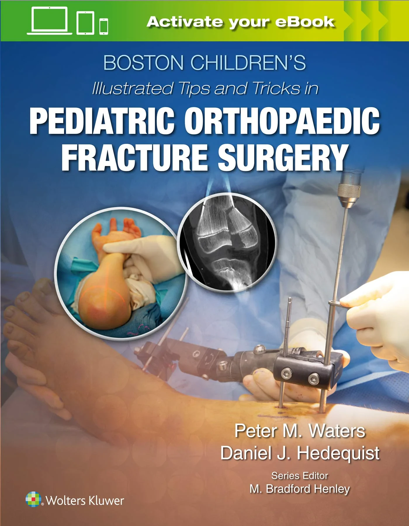 Coperta cărții "Boston Children&amp;#146;s Illustrated Tips and Tricks in Pediatric Orthopaedic Fracture Surgery" de autor necunoscut