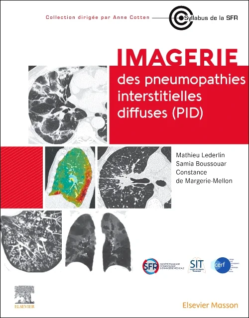 Imagerie des pneumopathies interstitielles diffuse...