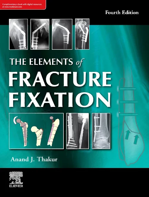 The elements of fracture fixation, 4e