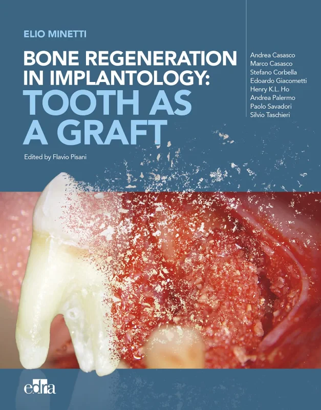 Coperta cărții "Bone regeneration in implantology: tooth as a graft" de autor necunoscut