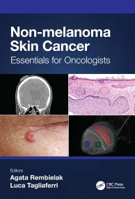 Non-melanoma Skin Cancer. Essentials for Oncologis...