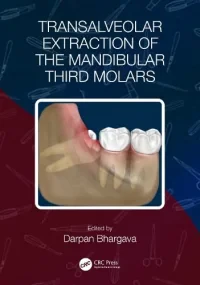 Transalveolar Extraction of the Mandibular Third M...