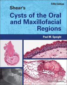 Shear&#8242;s Cysts of the Oral and Maxillofacial ...
