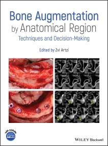Bone Augmentation by Anatomical Region: Techniques...