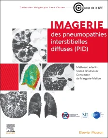 Imagerie des pneumopathies interstitielles diffuse...