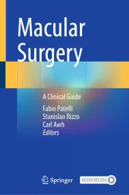 Macular Surgery: A Clinical Guide