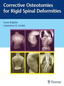 Corrective Osteotomies for Rigid Spinal Deformitie...