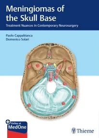 Meningiomas of the Skull Base: Treatment Nuances i...