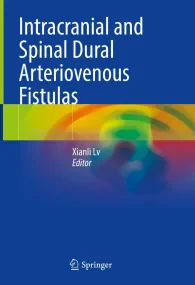 Intracranial and Spinal Dural Arteriovenous Fistul...