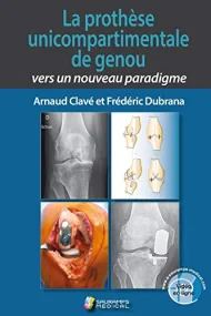 LA PROTHESE UNICOMPARTIMENTALE DE GENOU